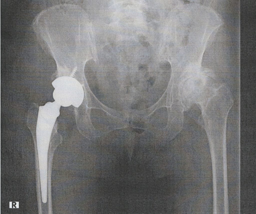 人工股関節置換手術後の画像200608
